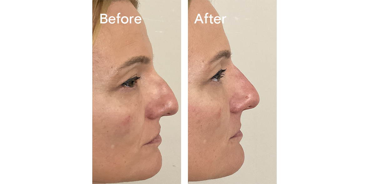 Patient Before And After Non-Surgical Rhinoplasty