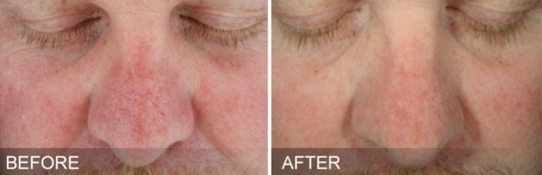 Hydrafacial before and after for sun damage