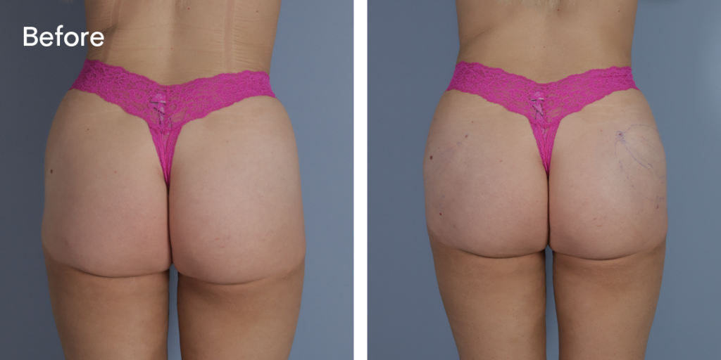 A patient before and after buttock injections