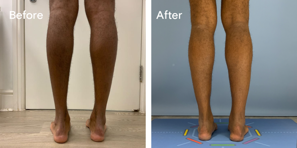 Patient before and after calf augmentation