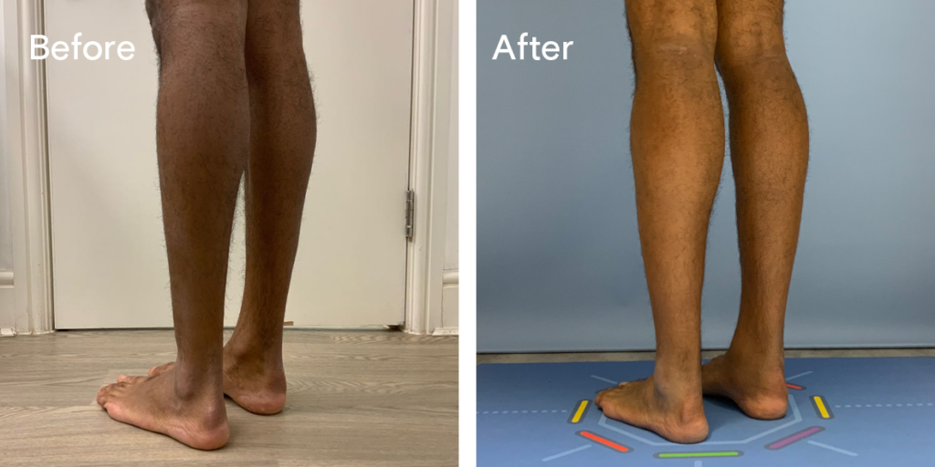 Patient Before And After Calf Augmentation