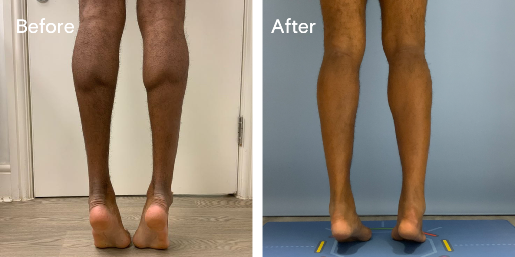 Patient before and after calf augmentation