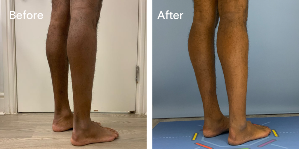 Patient Before And After Calf Augmentation