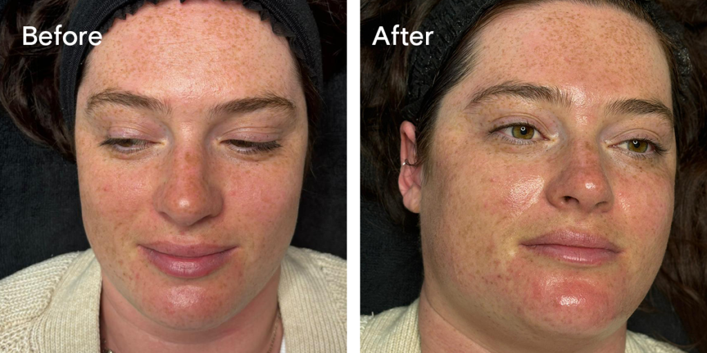 A patient before and after hydrafacial