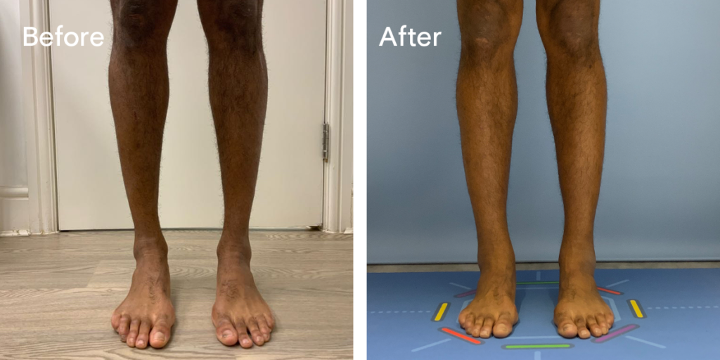 Patient before and after calf augmentation