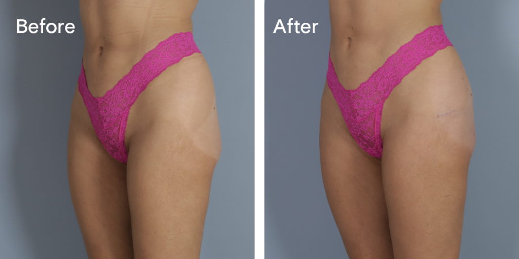 A Patient Before And After Buttock Injections