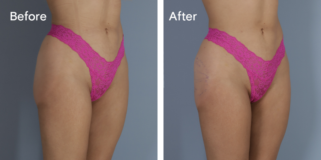 A Patient Before And After Buttock Injections