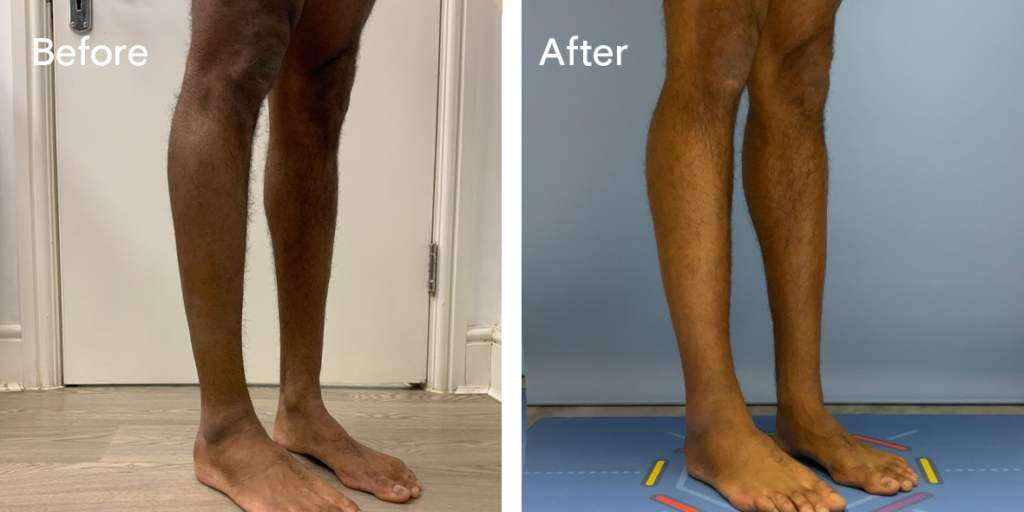 Patient before and after calf augmentation