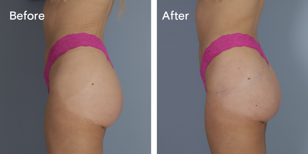 A patient before and after buttock injections