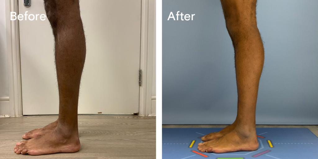 Patient Before And After Calf Augmentation