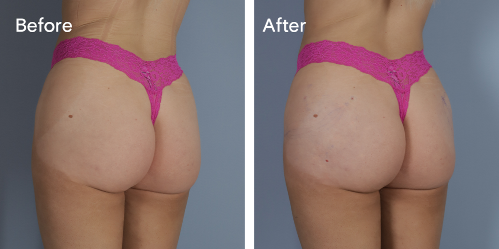 A patient before and after buttock injections