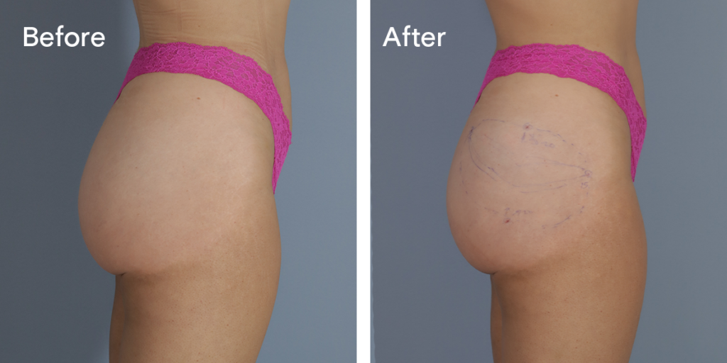 A Patient Before And After Buttock Injections