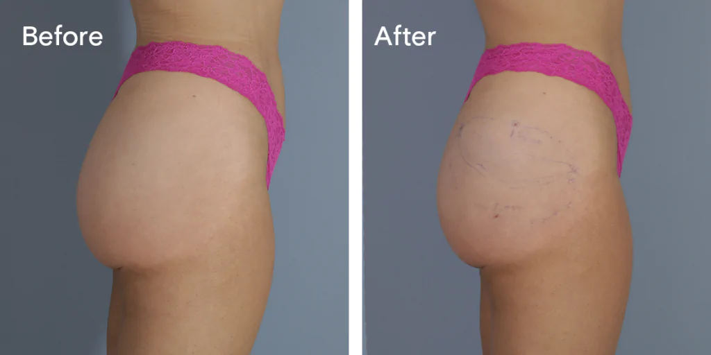 A Patient Before And After Buttock Injections