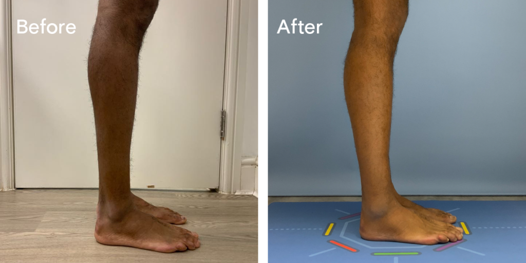 Patient Before And After Calf Augmentation