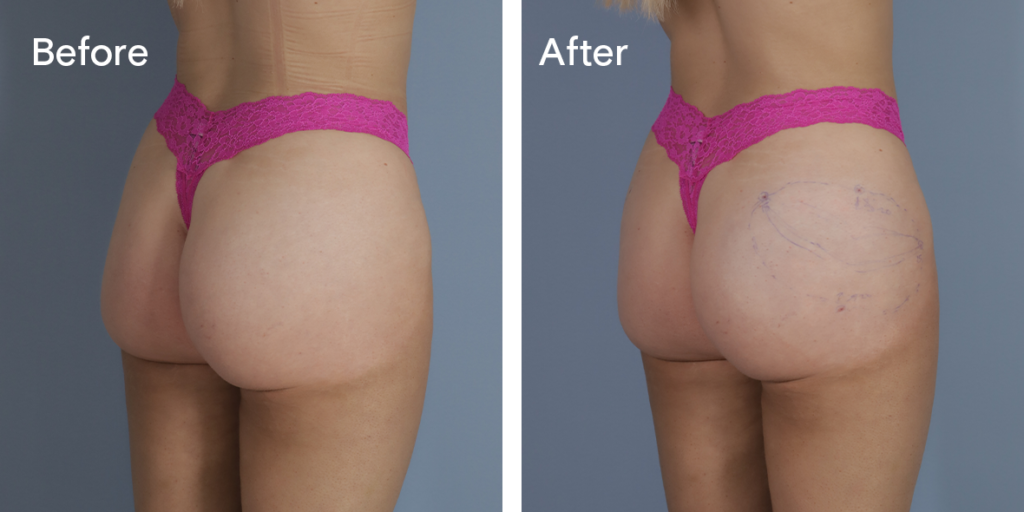 A Patient Before And After Buttock Injections