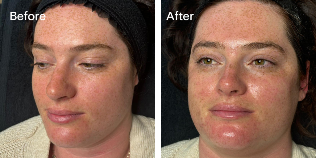 A patient before and after hydrafacial