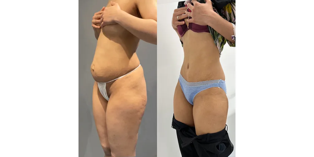 Before And After Of Abdominoplasty Patient