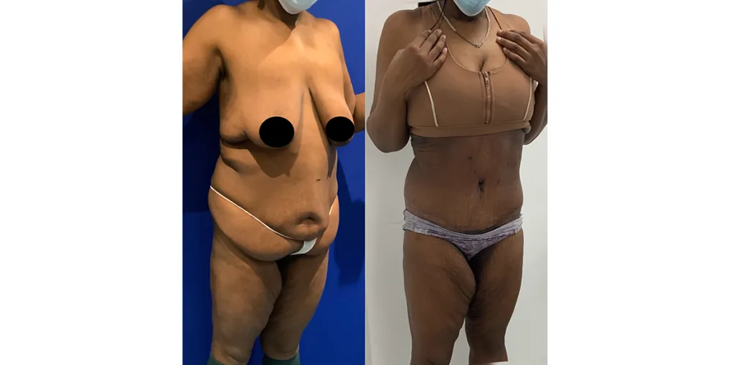 Before And After Of Abdominoplasty Patient