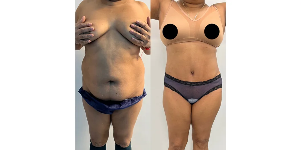 before and after of abdominoplasty patient