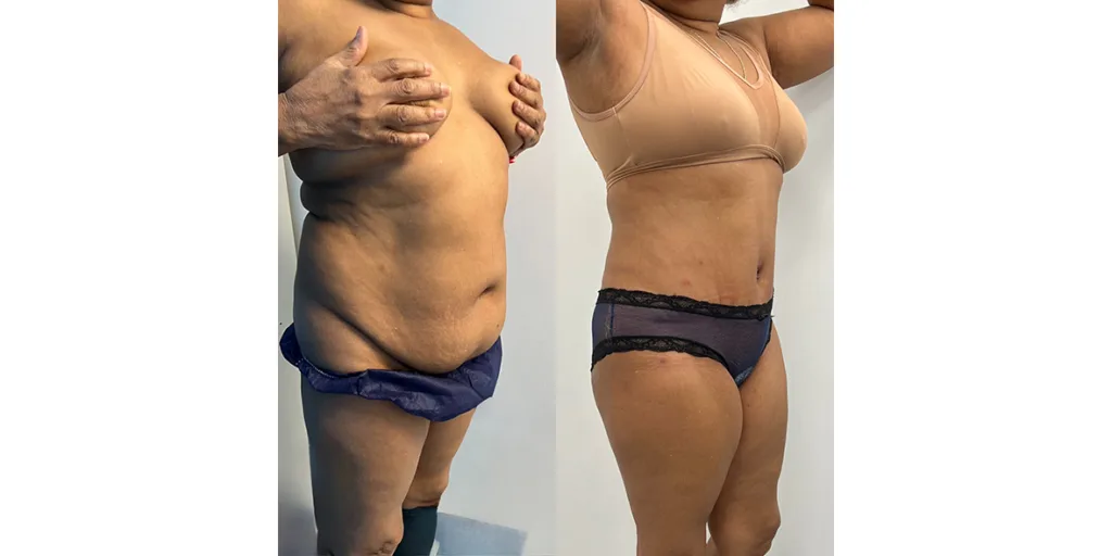 before and after of abdominoplasty patient