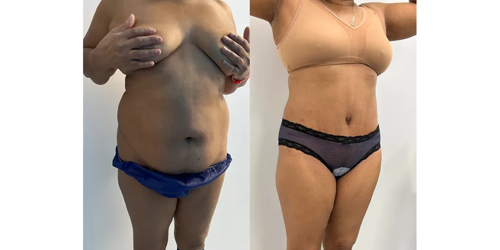 before and after of abdominoplasty patient