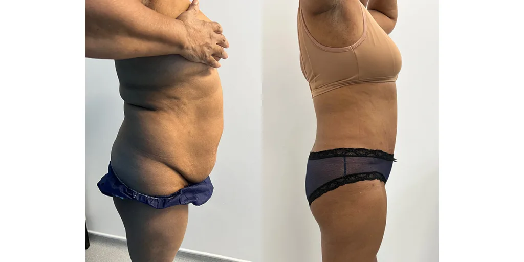 Before And After Of Abdominoplasty Patient