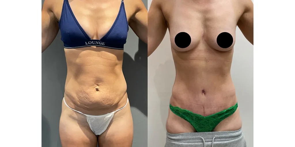 before and after of abdominoplasty patient