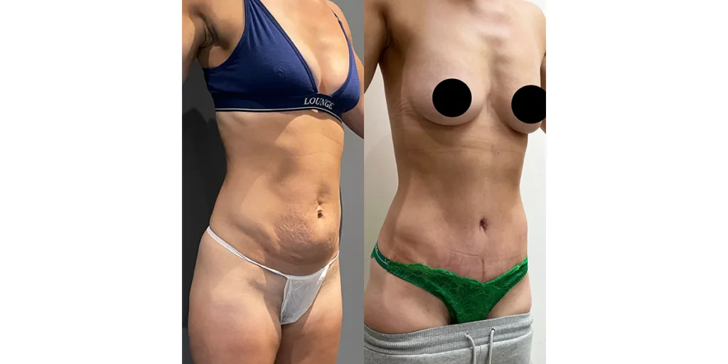 Before And After Of Abdominoplasty Patient