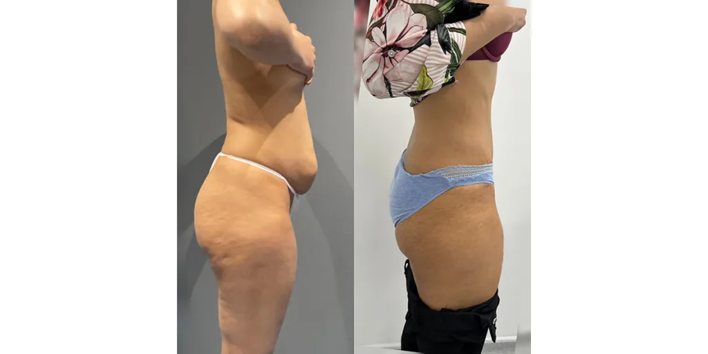 Before And After Of Abdominoplasty Patient