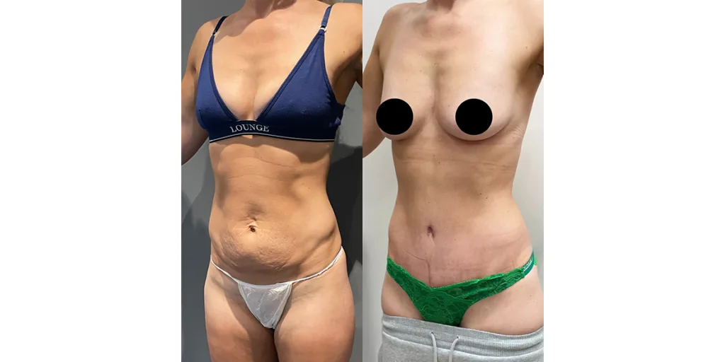 before and after of abdominoplasty patient