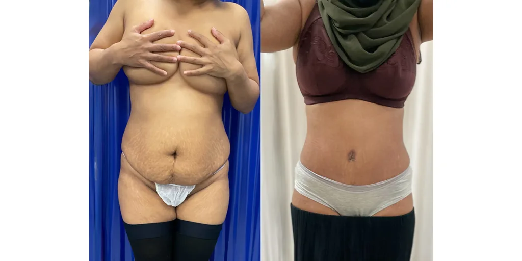 before and after of abdominoplasty patient