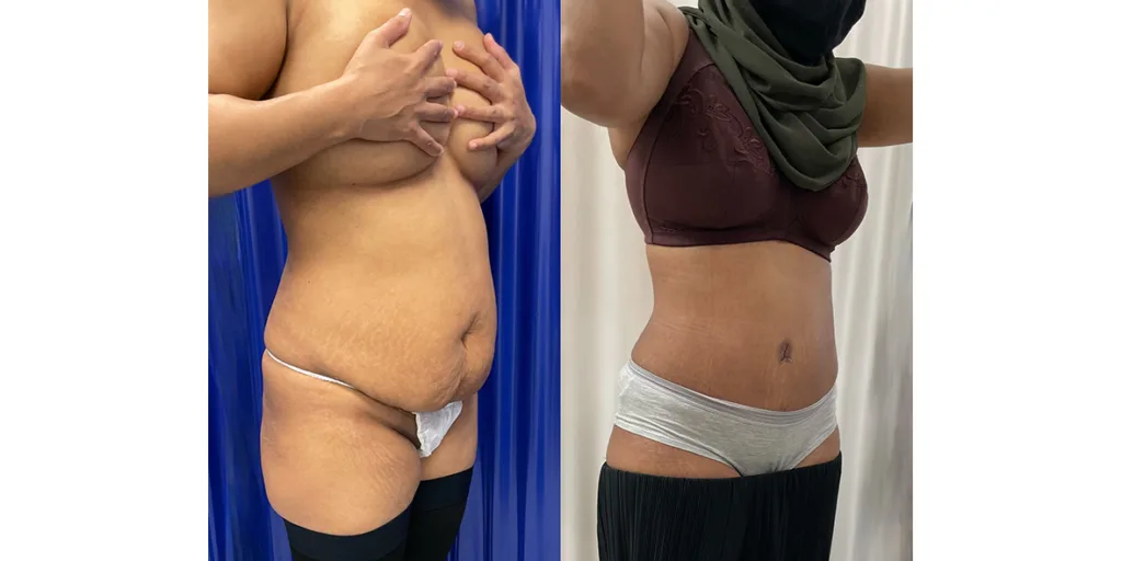 before and after of abdominoplasty patient