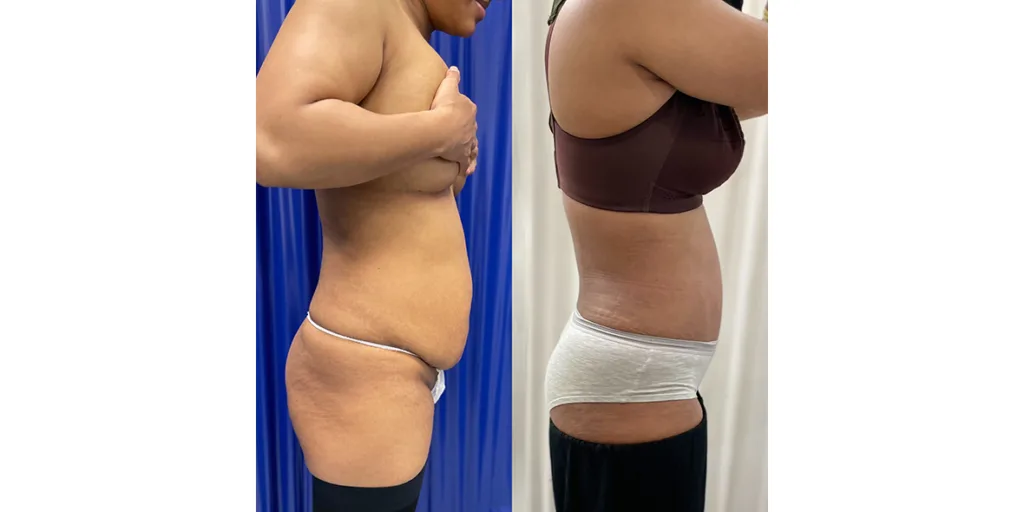 Before And After Of Abdominoplasty Patient