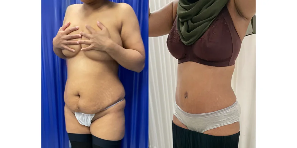 Before And After Of Abdominoplasty Patient