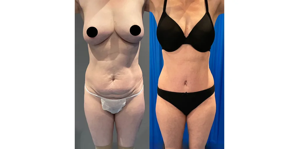 Before And After Of Abdominoplasty Patient