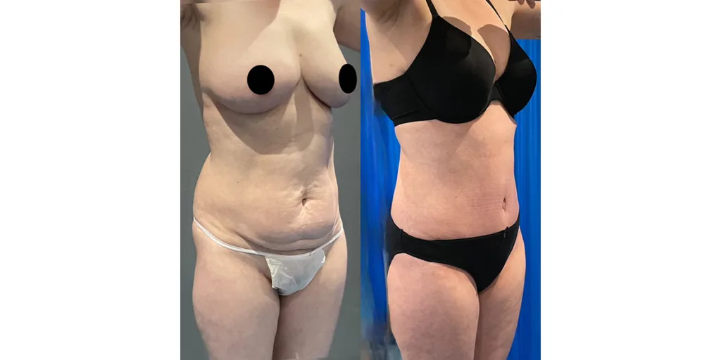 before and after of abdominoplasty patient