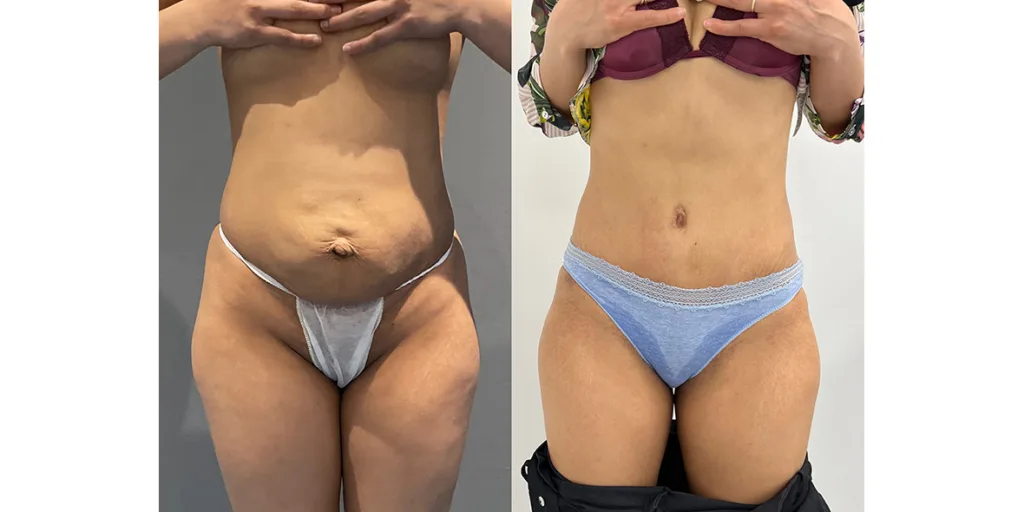 before and after of abdominoplasty patient