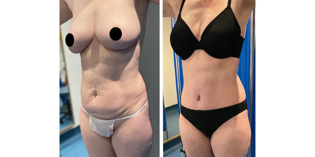 Before And After Of Abdominoplasty Patient