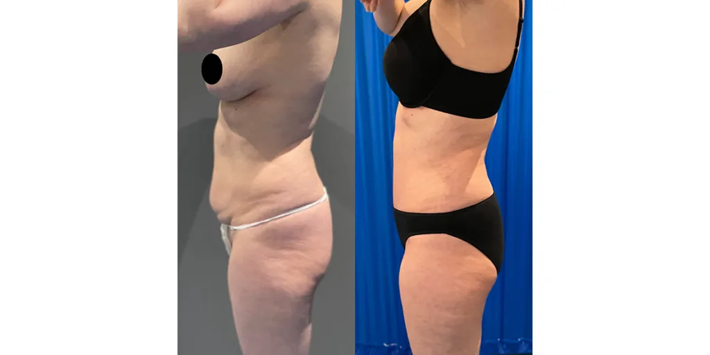 before and after of abdominoplasty patient