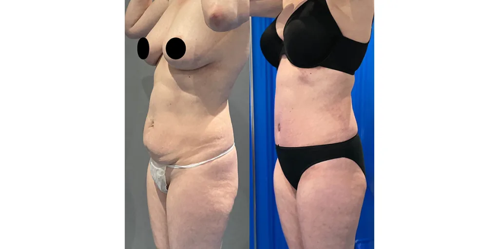 before and after of abdominoplasty patient