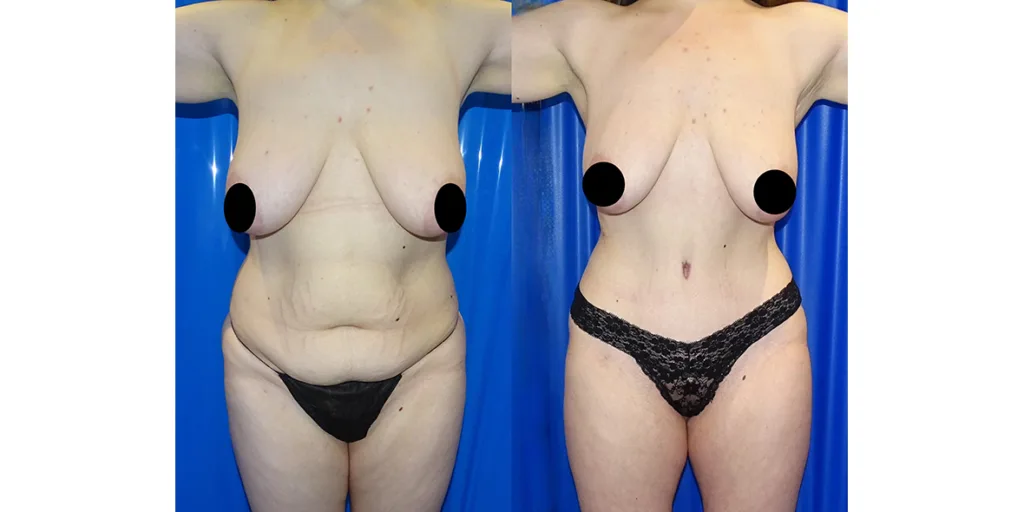 before and after of abdominoplasty patient