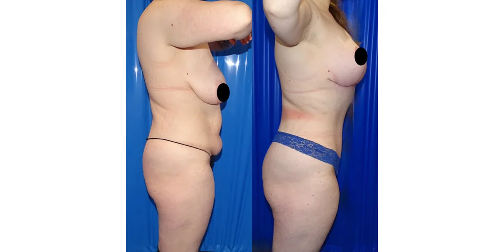 before and after of abdominoplasty patient