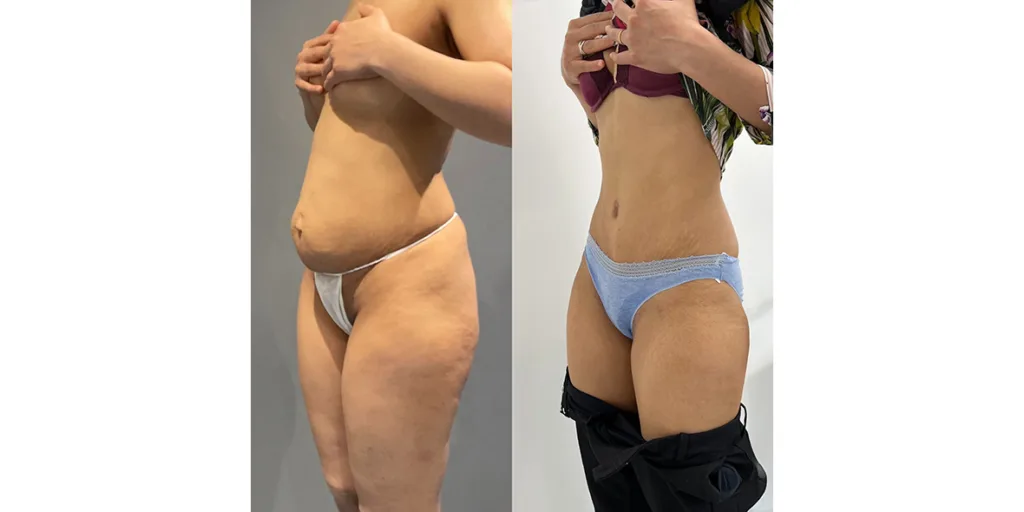 before and after of abdominoplasty patient