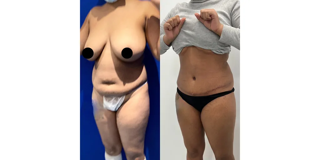 before and after of abdominoplasty patient