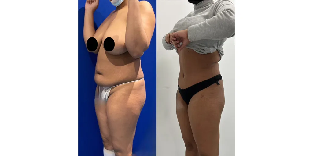 Before And After Of Abdominoplasty Patient