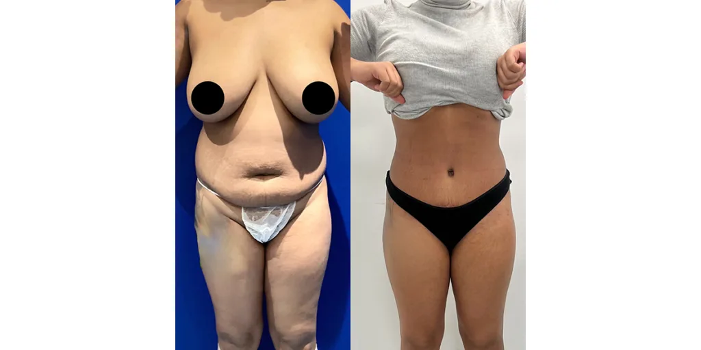 Before And After Of Abdominoplasty Patient