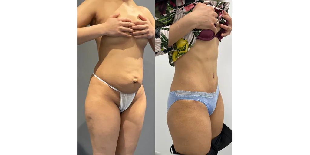 Before And After Of Abdominoplasty Patient