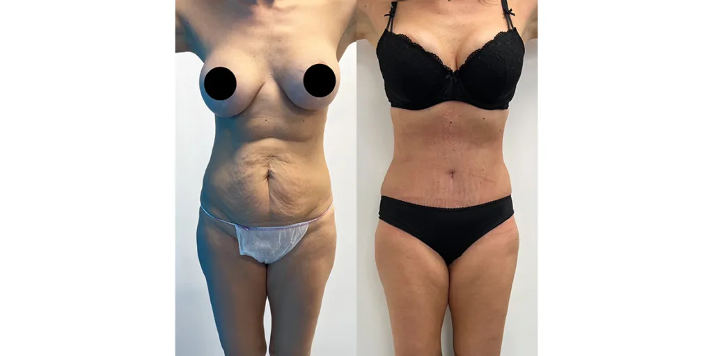 before and after of abdominoplasty patient