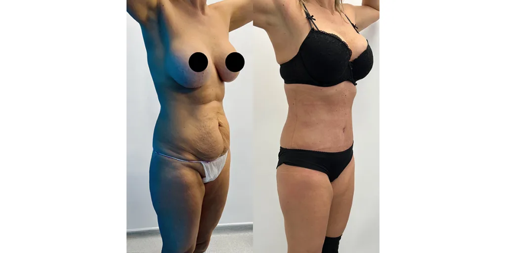 before and after of abdominoplasty patient