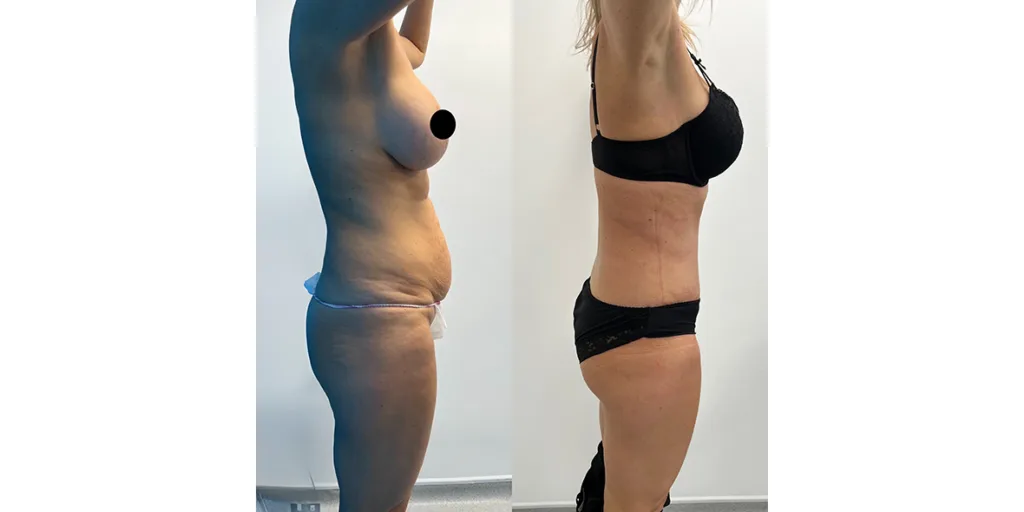 before and after of abdominoplasty patient